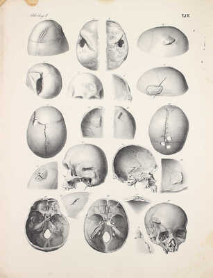 [Брунс В. Хирургический атлас. Наглядное описание хирургических заболеваний, инструментов, повязок и операций, необходимых для их лечения, составленное доктором Виктором Брунсом. Первый отдел. Мозг и оболочки]. Tübingen, 1854.
